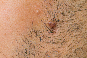 man stub with wart