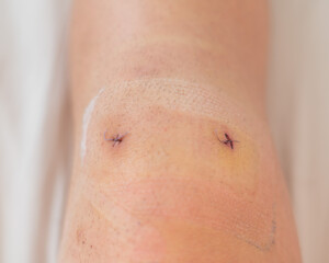 Close-up of a surgical suture on the knee after laparoscopic meniscus surgery.