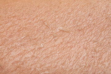 Detail of dry skin of woman. Dehydration due to the sun's rays without uv protection cream