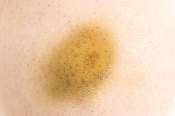 Close-up of bruise of hitting in the leg of woman