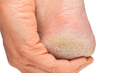 Fototapeta premium Cropped shot of a female heel with hardened skin with white background
