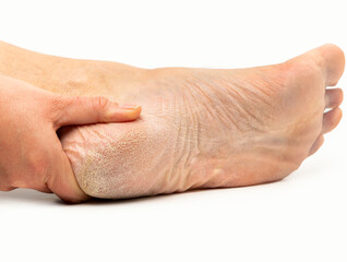 Cropped shot of a woman has dry skin and calluses on the feet