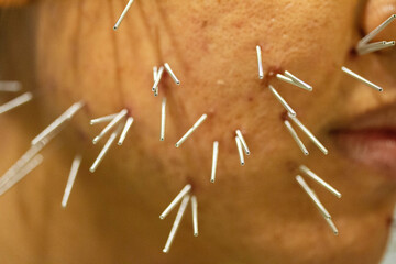 Closeup acupuncture face for acne or Melasma treatment