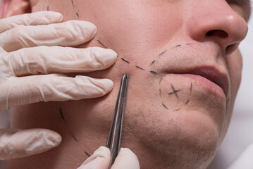 Man beauty procedure beard hair implant for senior man