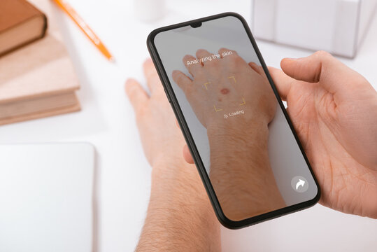 Man using a phone app to identify skin disease on his hand