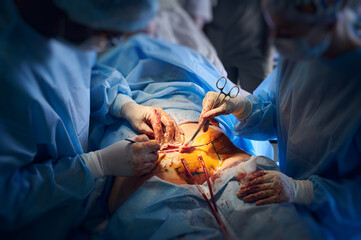 Close up of doctors in surgical suits performing abdominoplasty surgery in clinic. Male plastic...