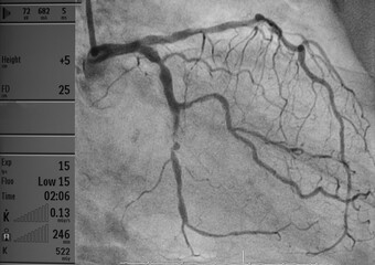 coronary artery angiography ,Coronary artery disease , left coronary angiography