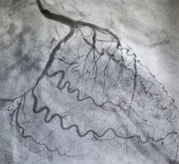 Obraz premium Coronary angiogram , medical x-ray for heart disease. Coronary artery disease.
