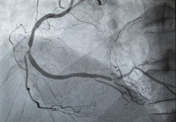 Coronary angiogram , medical x-ray for heart disease. Coronary artery disease.
