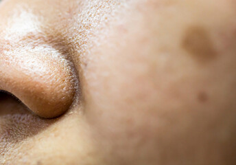 Woman 's problematic skin , acne scars ,oily skin and pore, dark spots and blackhead and whitehead...
