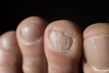 Close-up of male toes with a cracked nail
