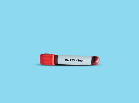 Test Tube with blood sample for CA 125 test. Tumor Marker for ovarian cancer. A medical testing concept in the blue background.