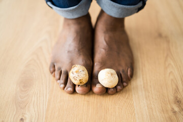 Feet Fungus Mushroom Between Toenail