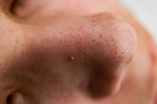 close up has skin problem, large pores, whitehead and blackhead pimple