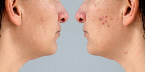 Obraz premium Skin care concept, woman with acne and with perfect skin.