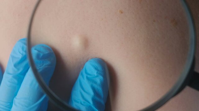 The doctor shows an atheroma or wen on the patient's body