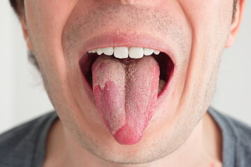 Caucasian male exposed tongue with yeast candida infection unrecognizable close up front view