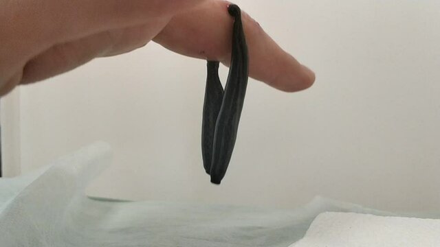 Treatment of a damaged finger joint with hirudotherapy. Leeches sucking blood on a human finger.
