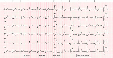 ECG example of a pacemaker 12-lead rhythm