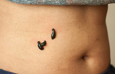 Ayurvedic medical leech liver treatment