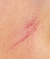 A wound on human skin.