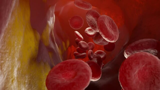 Cholesterol plaque in an artery, Blood vessel with flowing blood cells. 3D animation