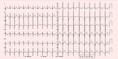 ECG example of a normal 12-lead sinus rhythm of pediatric patient