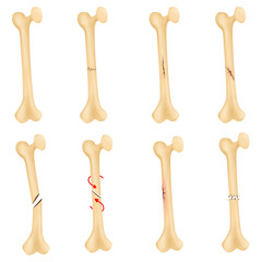 A broken bone is a fracture.