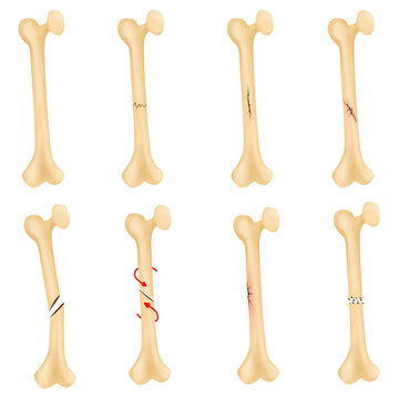 A broken bone is a fracture.