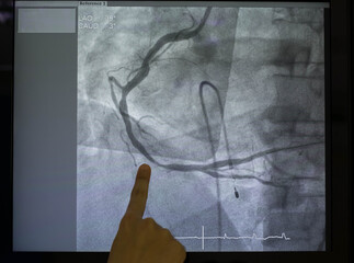 Coronary angiogram , medical x-ray for heart disease. Coronary artery disease.