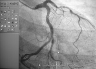 Coronary angiogram , medical x-ray for heart disease. Coronary artery disease.