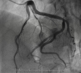 Coronary angiogram , medical x-ray for heart disease. Coronary artery disease.
