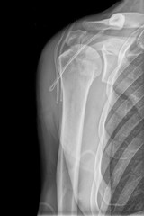Xray image of shoulder isolated on black background. Chronic dislocation of the long biceps tendon after Operation. (reconstruction of the cranial third of the SSC tendon corkscrew anchor) 