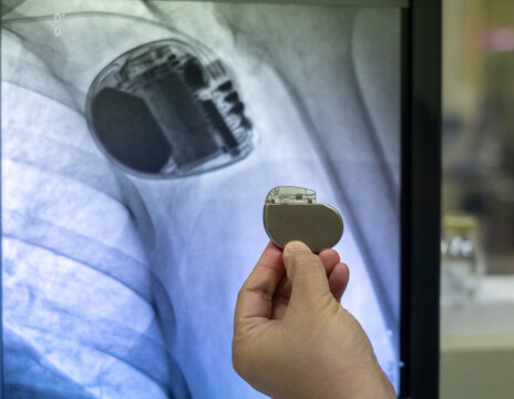 permanent pacemaker implantation device. This image demonstrates Permanent Pacemaker (PPM) on hands.