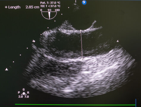 Echocardiography (ultrasound) machine. doppler of aortic stenosis