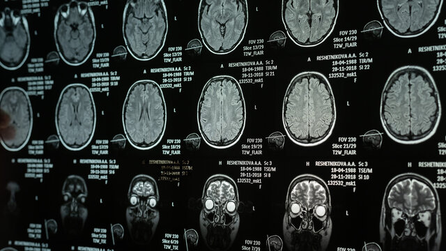 Close-up of magnetic resonance imaging of the human brain