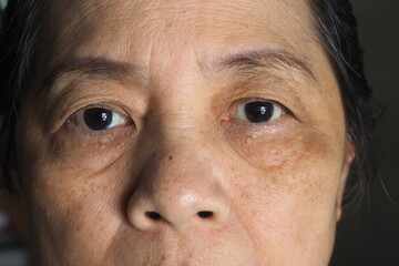 Closeup of wrinkles in Asian woman face skin in deep layers Skin repair and treatment concept for elderly and aged people. Healthcare medical eye lift and aesthetic concept