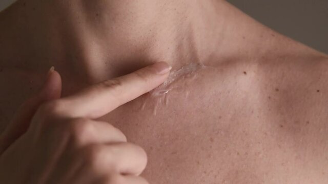 Woman applying treatment cream on surgery scar on her collarbone