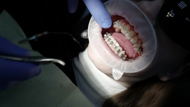 Close-up of a doctor and a patient with a mouth dilator in a dental office, braces on the teeth, various procedures are performed with the help of dental instruments.