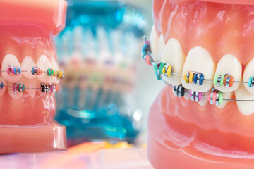 orthodontic model and dentist tool - demonstration teeth model of varities of orthodontic bracket...