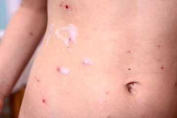 Therapy against the virus of Varicella has measles, chicken pox, rubella