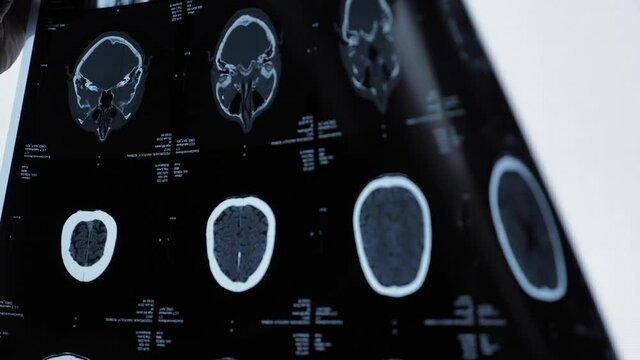 Magnetic resonance imaging of an older man's brain after a traumatic brain injury, which shows that the brain is damaged. Tomographic image of the head