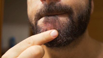 Detail of the man's chin with seborrheic dermatitis in the beard area. Dry skin peels off and causes itching and dandruff.