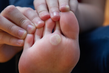 Children's foot with problem areas on the skin, dry corn. Plantar wart of the foot. Unhealthy foot...