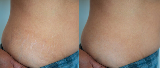 Image before and after skin stretch marks removal treatment.