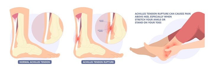 Achilles tendon rupture injury Feet calf test range of motion slight ache problem limb Thompson Simmonds	 - obrazy, fototapety, plakaty