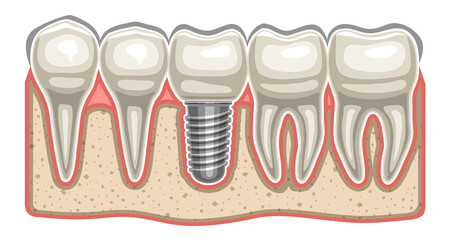 Vector illustration of Dental Implant, 5 human teeth in a row and ceramic artificial tooth with screw in bone jaw, decorative horizontal sticker for professional denture clinic on white background.