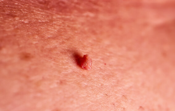 Soft fibroma in male under belly, macro photo. Dermatology problem concept. Selective focus