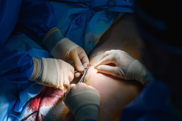 Phlebectomy operation. Surgical removal of veins