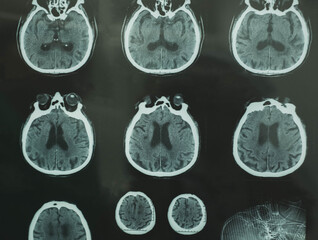 Close up series of a CT scan with human head on it. X-ray medicine concept.